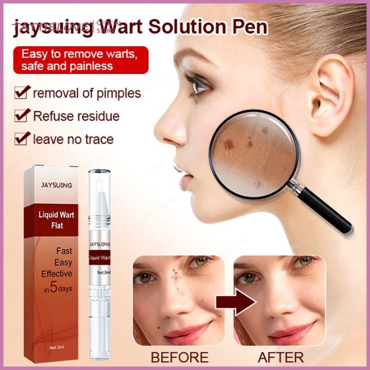 Body Wart Remove Flat ( pack off 2 )